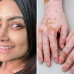 Actress Mamta Mohandas diagnosed with autoimmune disease vitiligo; Here know all about the disorder
